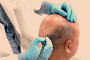 Read more about the article Who Is Not a Good Candidate for PRP Hair Transplant?
