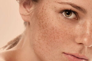 Read more about the article What Do Dermatologists Recommend For Hyperpigmentation