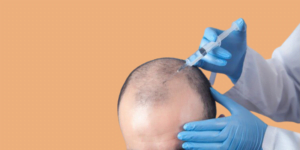 Read more about the article Important Information About PRP Treatment For Hair loss