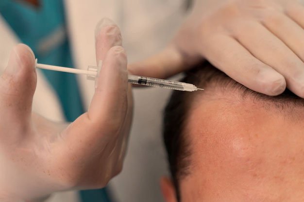 You are currently viewing 5 Things to Know Before Getting PRP Treatment for Hair Loss