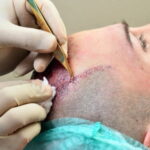 Hair Transplantation prp treatment for hair loss in gurgaon